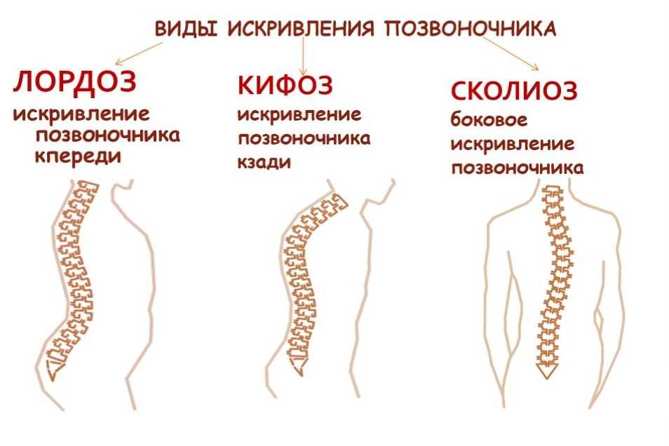 У неона кривой позвоночник