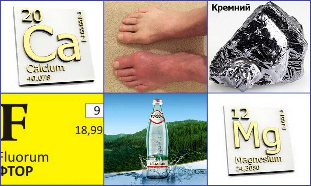 Минеральная вода для лечения подагры - сустав жив